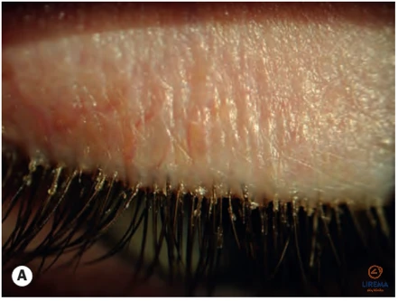 Vokų krašto ligos - traiškanotos, sulipusios blakstienos