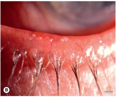 Vokų krašto ligos - riebiu sekretu padengtas voko kraštas su sulipusiomis blakstienomis