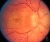 Neuroretinitas