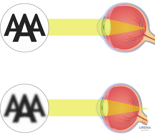 Normaregė (emetropa) ir toliaregė akis