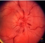 Regos nervo disko (RND) uždegimas