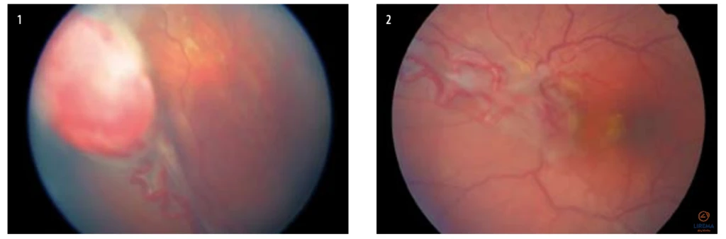 Stambi tinklainės kapiliarinė hemangioma