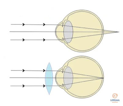 Toliaregystės korekcija išgaubtais lęšiais