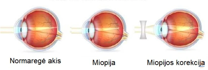 Trumparegystė: normaregė akis, miopija, miopijos korekcija