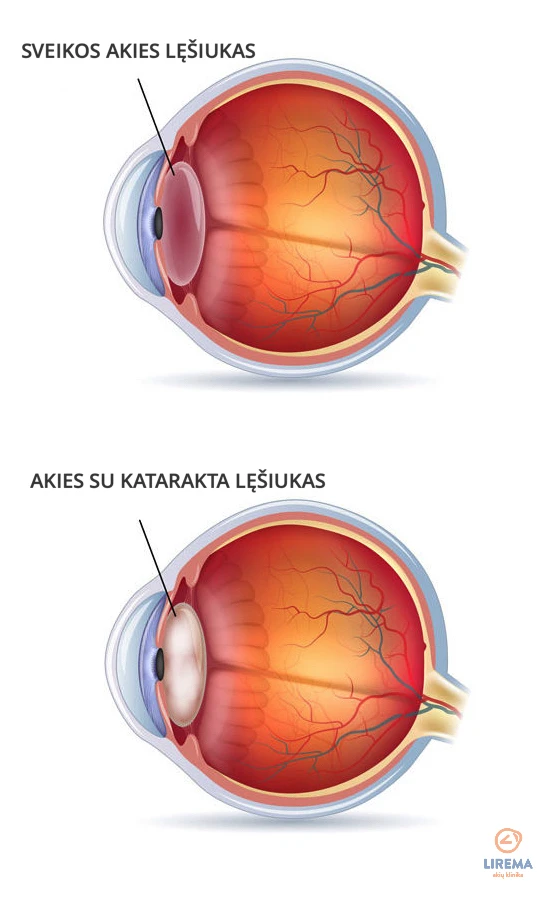 sveikos akies lęšiukas ir akies su katarakta lęšiukas